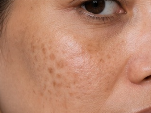 Uneven Tone & Dark Spots