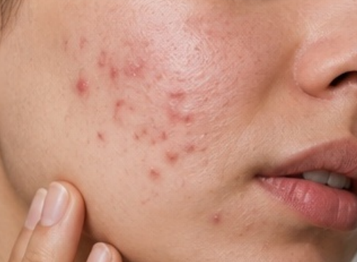 Acne & Blemishes