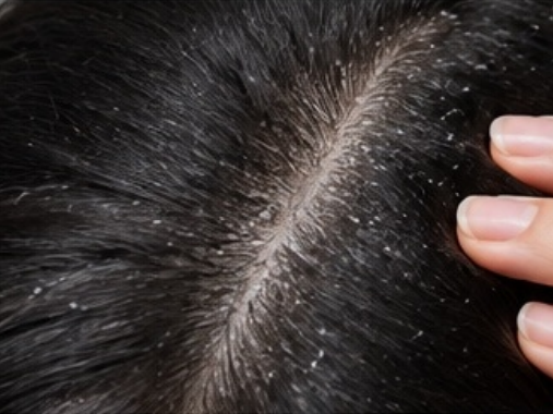 Dandruff & Scalp Care