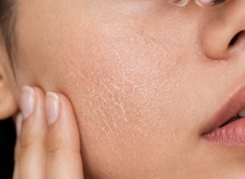 Dry & Dehydrated Skin